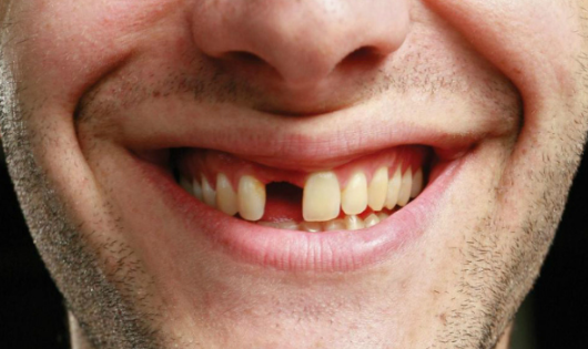 Bị gãy răng có điềm gì không may mắn? 